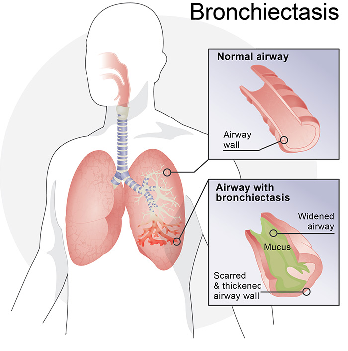 Bronchiectasis illustration